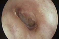 Dry perforation of R ear drum