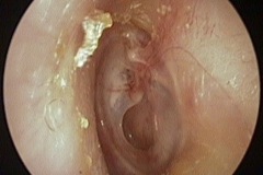 Dry central perforation, L ear