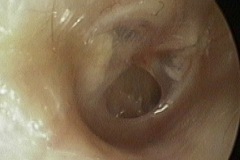 Dry perforation R ear, tympanosclerosis in posterior margin of TM