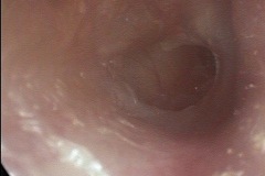 Dry perforation R ear