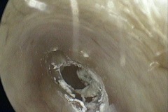 Dry perforation and crusts, L ear