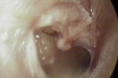 Dry perforation of scarred R ear drum