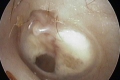 Dry perforation of tympanosclerotic L ear drum