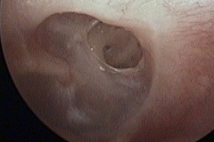 Dry perforation, L ear, exposes stapedius tendon
