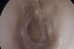 Dry perforation, L ear