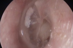 Dry perforation, posterior, L ear