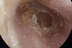 Dry perforationR ear, dry wax flakes and threads of cotton wool used by patient to try and clean and dry discharge