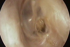 Dry postero-inferior perforation, L ear