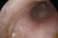 Dull drum, middle ear effusion, R ear