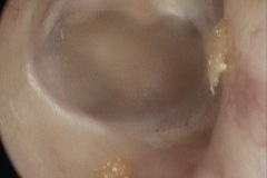 Healed large perforation, thin TM,L ear