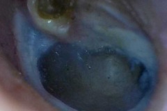 Healed perforation of most of TM, attic debris covering attic cholesteatoma, L ear