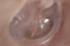 Healed perforation, thin anterior segment of TM, R ear