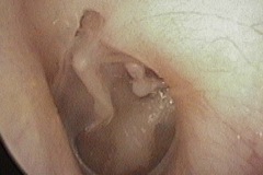 Healed perforation, thin drum, small attic retraction, eroded LPI just touches stapes head, L ear