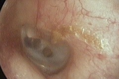 Healed perforations, this patches of drum, L ear