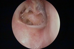 Large moist perfoartion, exposes, thinned ISJ