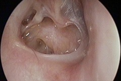 Large moist perforation, exposes thinned ISJ