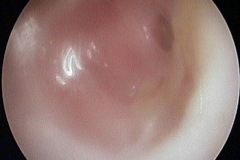 Large wet almost featureless perforation, thick mucosa filling middle ear, entrance to Eustachian tube mimics small anterior perforation, R ear