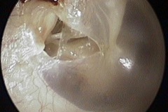 Perforated pocket, postero-superior drum, exposing stapes and stapedius tendon, R ear, 1