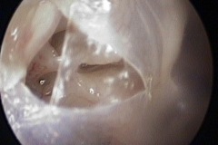 Perforated pocket, postero-superior drum, exposing stapes and stapedius tendon, pyramid and entry to sinus tympani, R ear, 3