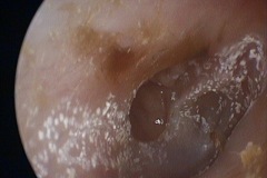 Perforated postero-superior retraction pocket, R ear, margin adherent to eroded Incudo-Stapedial joint