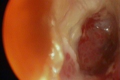 Perforated, atelectatic, granular, R drum and middle ear