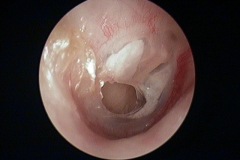 Perforation R ear, dry, with t'sclerosis patches