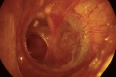 Perforation, anterior-inferior, moist, slightly inflammed TM, Mucosal CSOM, L ear