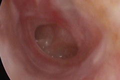 Perforation, central, wet, mucosal, Tubo-Tympanic, L ear