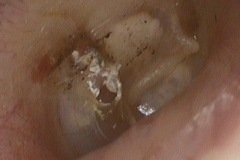 Perforation. small, dry, posterior TM, R ear