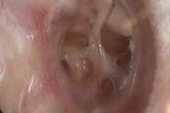 Perforations and scars, Mucosal CSOM, R ear