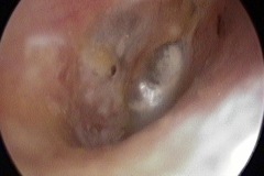 Pinhole dry perforation R ear, some tympanosclerosis of remainder of TM