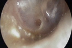 Small dry perforation of inferior part of ear drum,small areas of white tympanosclerosis in other areas of TM