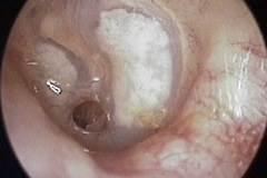 Small inferior central perforation, moist, plaques of tympanosclerosis in TM