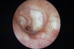 Small inferior central perforation, moist, plaques of tympanosclerosis in TM