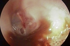 Small inferior wet perforation, L ear