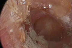 Subtotal perforation, moist, mucosal, with fungal otitis externa, r ear