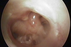 Subtotal wet perforation, L ear, exposed hypotympanic air cells and round window niche