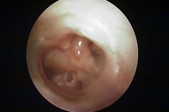 Subtotal wet perforation, L ear, exposed hypotympanic air cells and round window niche