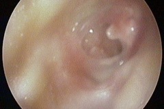 Wet central perforation, R ear, muco-purulent discharge