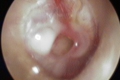 Wet central perforation, with granular polypoid margin