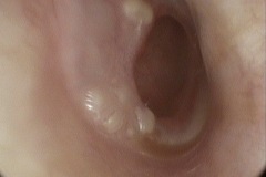 Wet perforation, R ear 2
