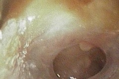 Wet perforation, R ear, discharge in canal