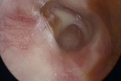 Wet perforation, R ear