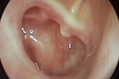 Wet perforation, muco-purulent discharge in middle ear, Incudo-Stapedila joint and stapediue tendon visible, R ear