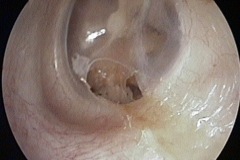dry perforation of inferior part of L ear drum, hypotympanic air cells seen through perforation