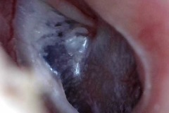 healed perforation causing thin area of TM, left ear, drum thick and scarred anteriorly