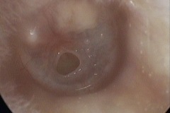 small wet perforation and mild myringitis, L ear, tympanosclerotic patch postero-superiorly