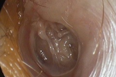Atelectasis and glue ear, TM retracted onto eroded ISJ , horizontal VII canal, and round window overhang, L ear