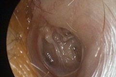 Atelectasis and glue, eroded tip of LPI, L ear