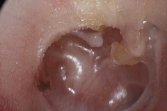 Atelectasis and glue, gross retraction of dull TM onto eroded LPI and promontory and round window recess, R ear